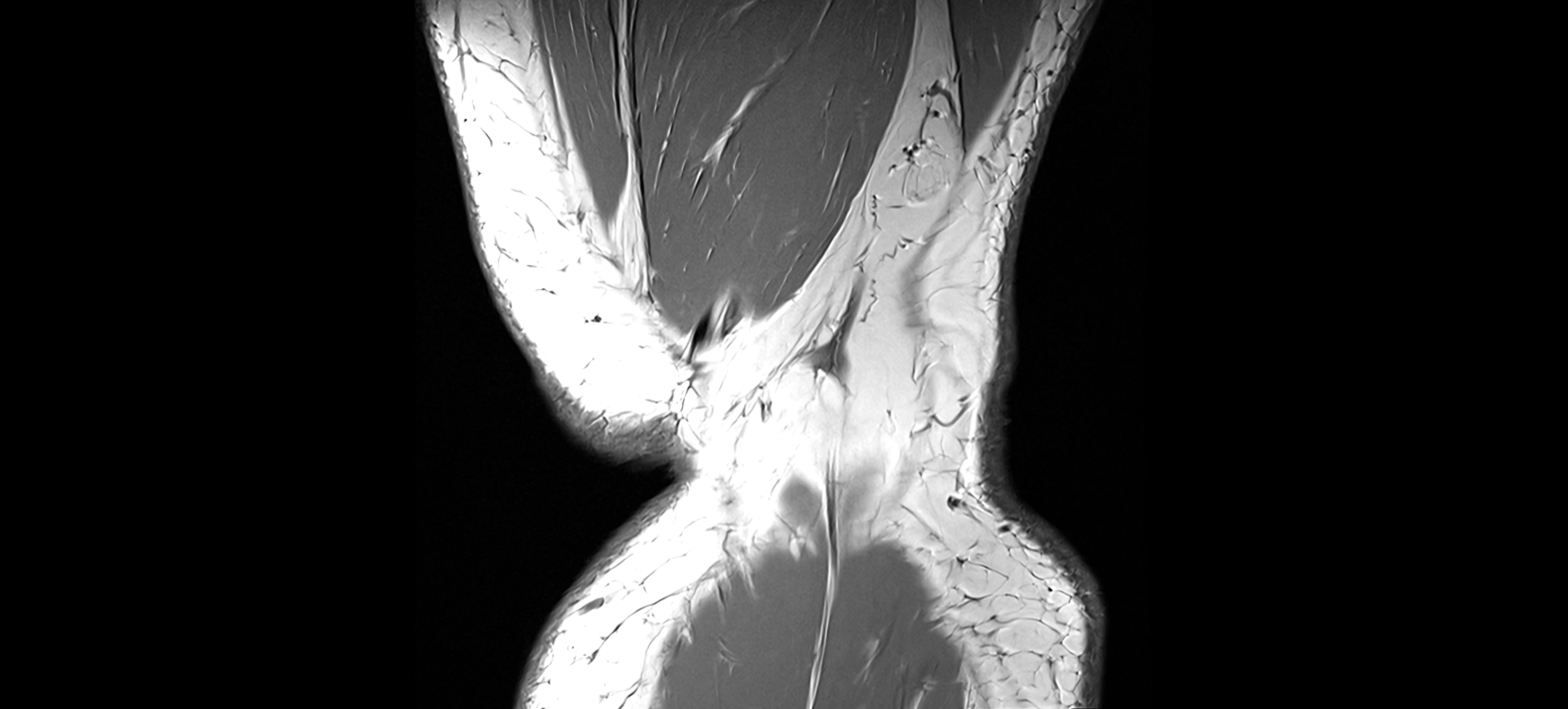 MRI coronal  ligaments cross sectional anatomy 3T  radiology  image-img-04001-00043.webp
